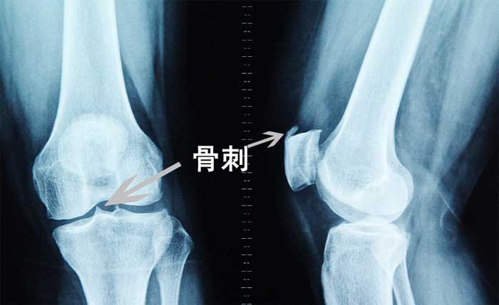 骨质增生骨刺及骨质疏松都与肾脏有密切关系